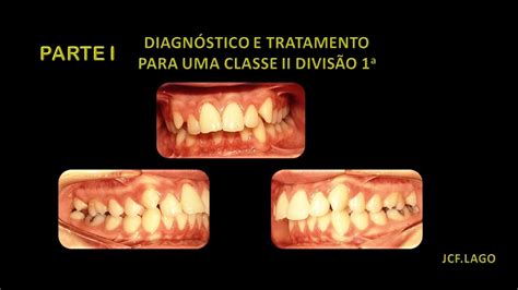 Como Saber A Diferenca Entre Classe 2 E Classe 3 Maquinas De Fenda